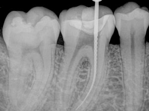 Terapia Endodontica